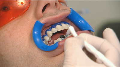 Los problemas de hacerse un blanqueamiento dental casero