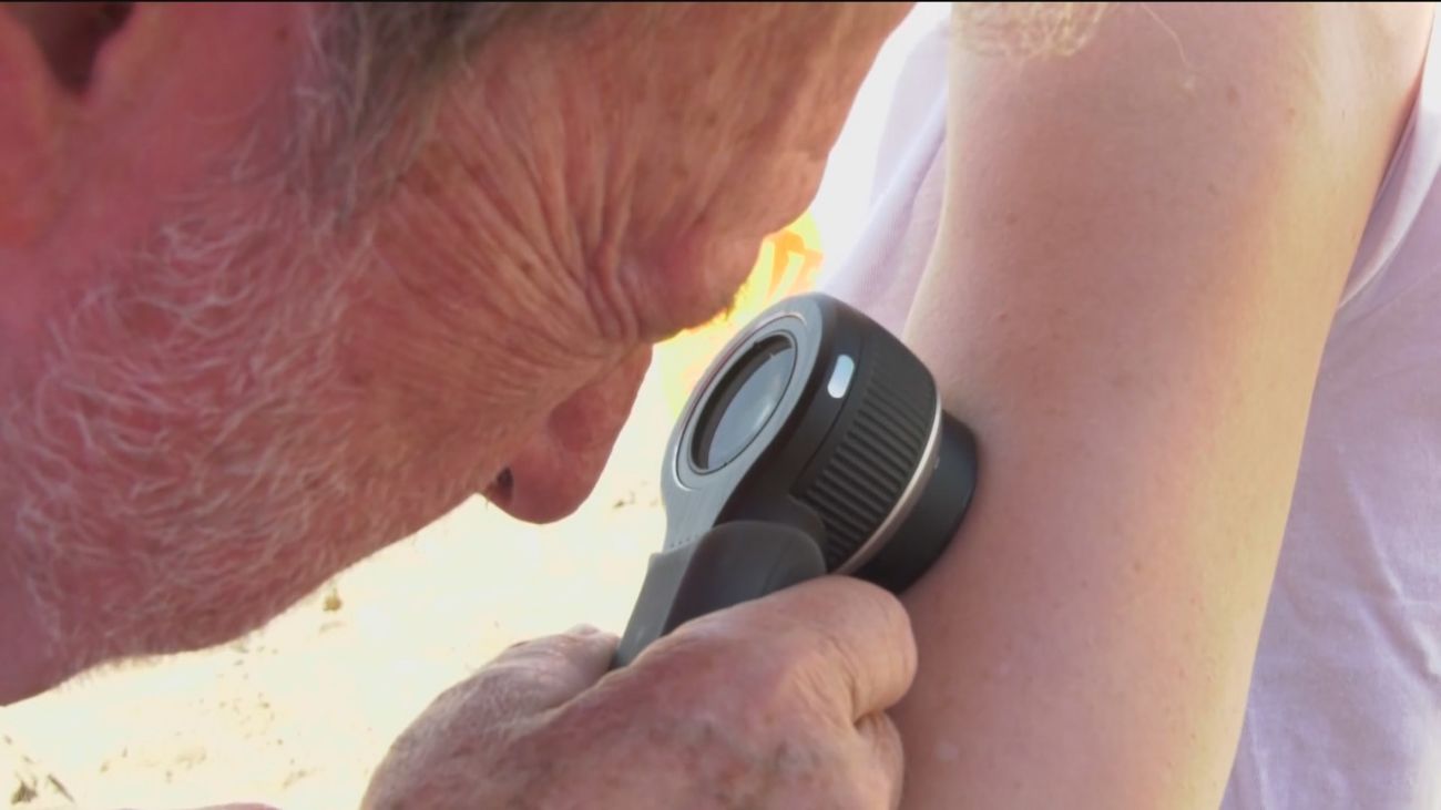 Las quemaduras solares antes de los 15 años son las que más elevan el riesgo de cáncer de piel