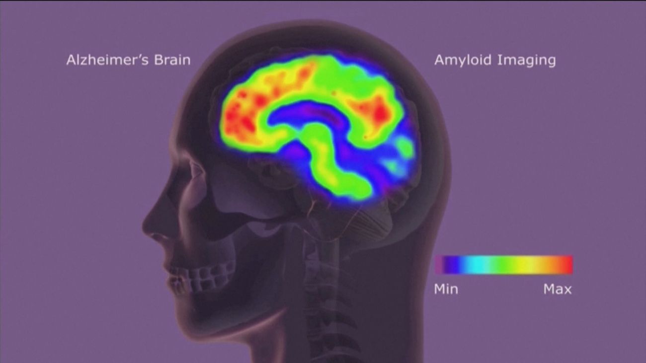 La actividad física y el contacto social ayudan a frenar los síntomas del alzhéimer