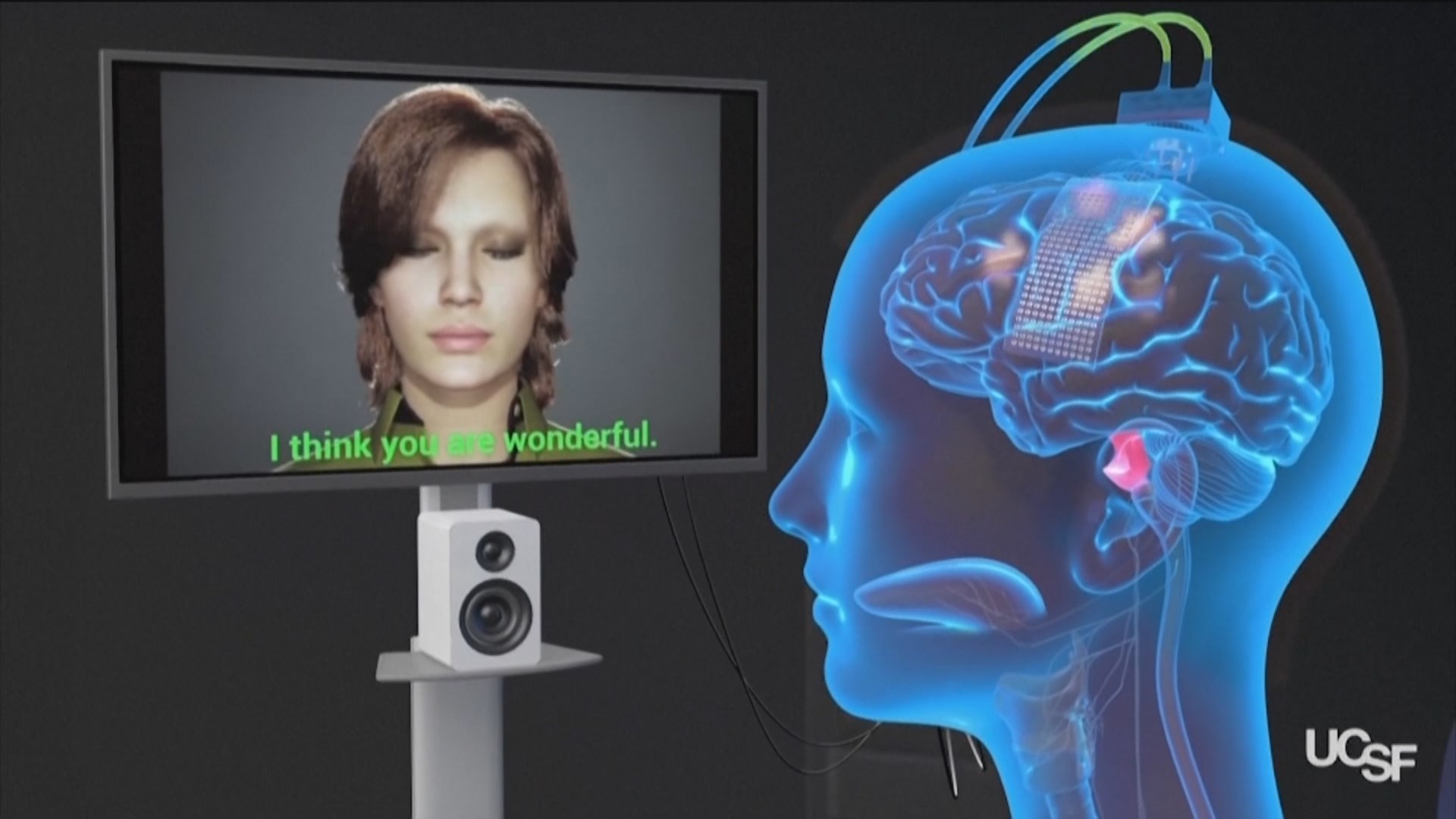 Inteligencia artificial e implantes cerebrales para 'devolver' el habla a pacientes con parálisis