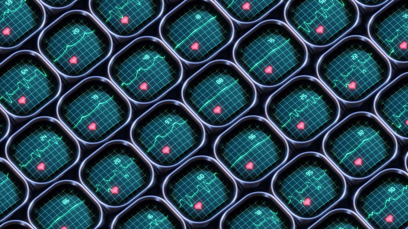 Los análisis de IA podrían ayudar a acelerar la detección de insuficiencia cardíaca