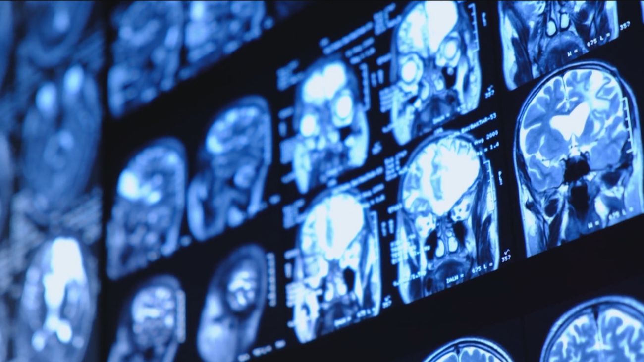 Un estudio descubre que los tumores cerebrales ‘hackean’ la comunicación entre neuronas