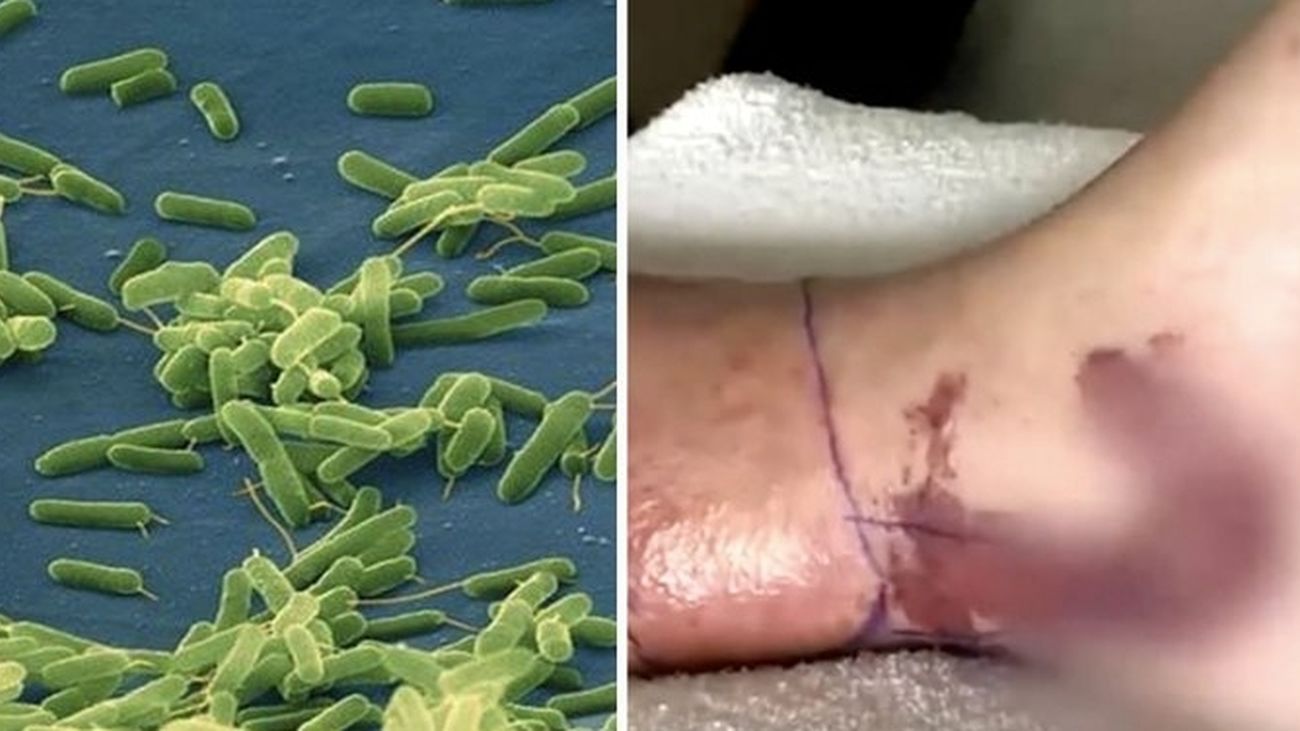 Bacteria 'come-carne'