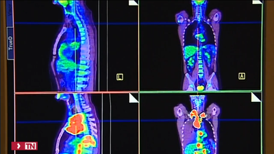 El análisis de ciertas proteínas en la sangre permite predecir qué órganos fallarán antes