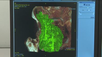 Los hospitales públicos de Madrid usarán la inteligencia artificial en radiología