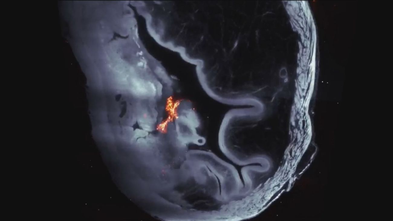 Logran reducir tumores de vejiga con nanorrobots que transportan el fármaco