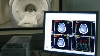 Descubren el primer contagio accidental del alzhéimer