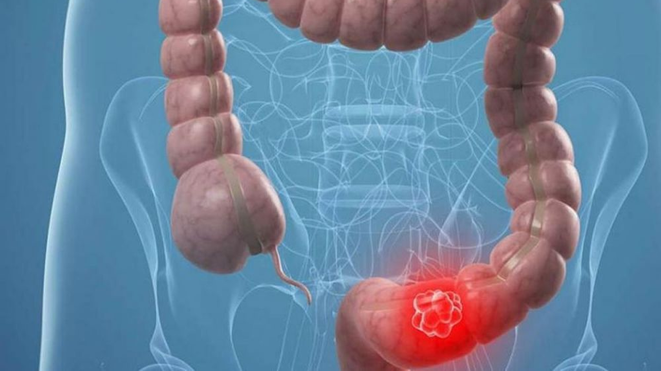 El cáncer sigue creciendo en España y ya es  una de las enfermedades más comunes