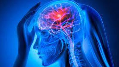 El ictus es la primera causa de muerte de las mujeres en España