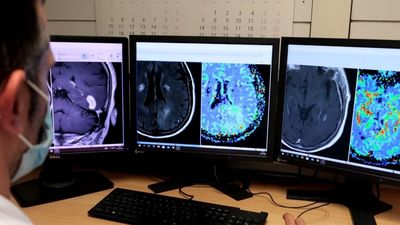 El Hospital Vall d'Hebron desarrolla una nueva herramienta de IA mejorará el diagnóstico de tumores cerebrales
