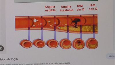 El infarto de miocardio es la enfermedad cardiovascular mortal más importante en España: ¿qué sabemos sobre ella?