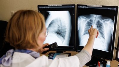 Los epidemiólogos alertan de la tendencia ascendente de los casos de tuberculosis