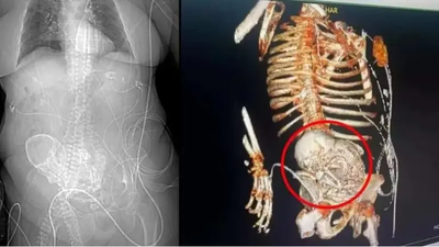 Una mujer brasileña con un feto calcificado desde hace 30 años muere en una operación