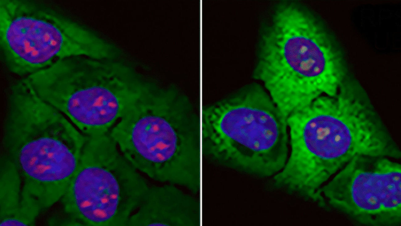 Células normales (izquierda) y células con acumulación de "proteínas basura" (verde fluorescente)