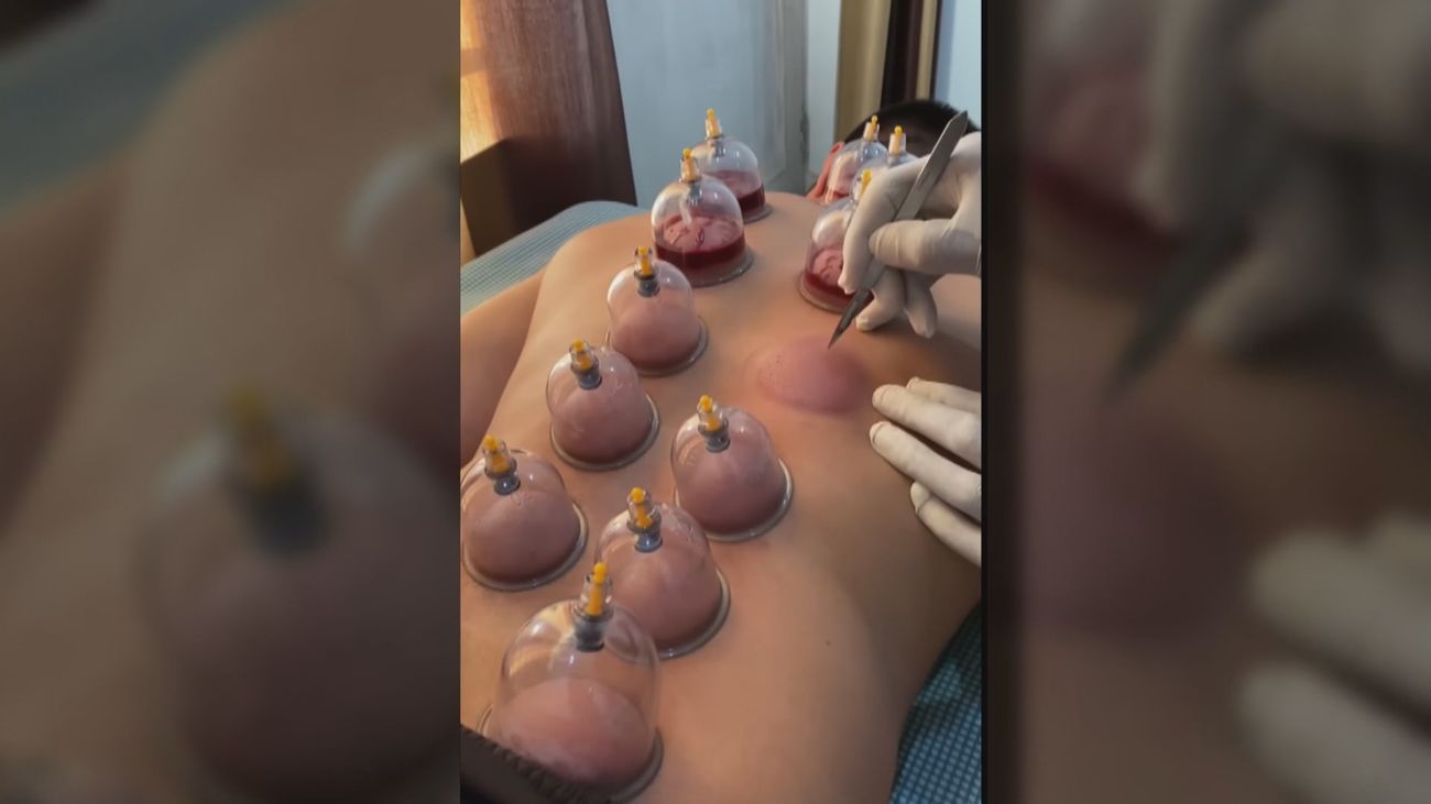 Sanidad amplía la lista de pseudoterapias con el taichi, la aromaterapia y la vacuoterapia