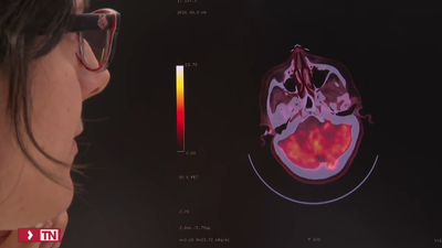El Hospital 12 de Octubre busca pacientes afectados por demencia con cuerpos de Lewy