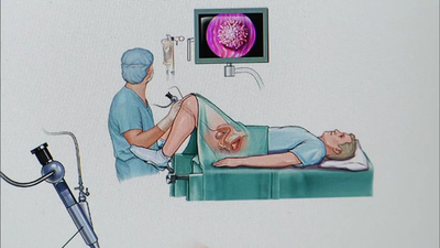 El Hospital 12 de Octubre lleva a cabo un ensayo clínico para la detección precoz del cáncer de vejiga