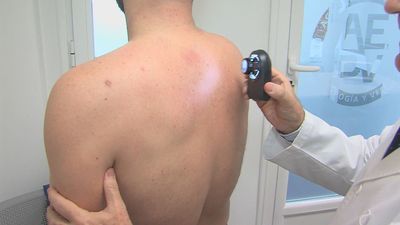 Arranca la campaña de prevención contra el melanoma con revisiones gratuitas durante el mes de junio