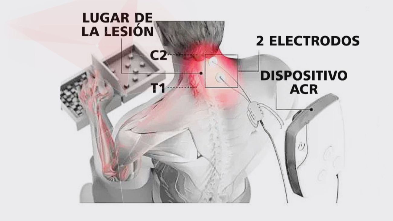 Una nueva terapia de estimulación eléctrica prometedora para pacientes tetrapléjicos