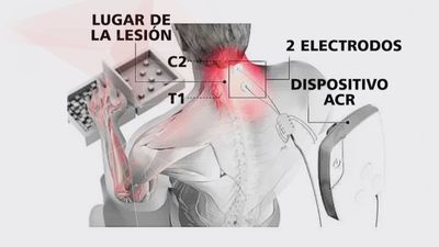 Una nueva terapia de estimulación eléctrica prometedora para pacientes tetrapléjicos