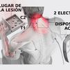 Una nueva terapia de estimulación eléctrica prometedora para pacientes tetrapléjicos