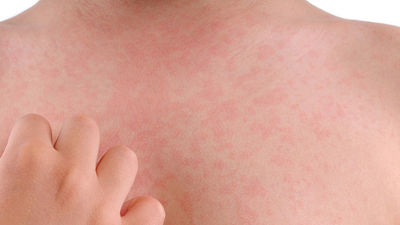 ¿Qué es el virus de la bofetada en niños?