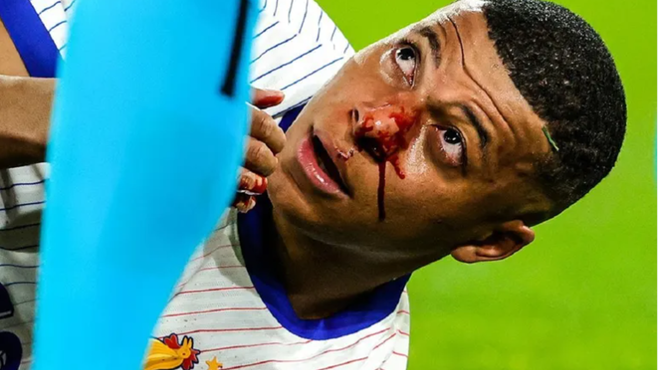 Mbappé se fractura la nariz, pero no se operará y jugará con máscara