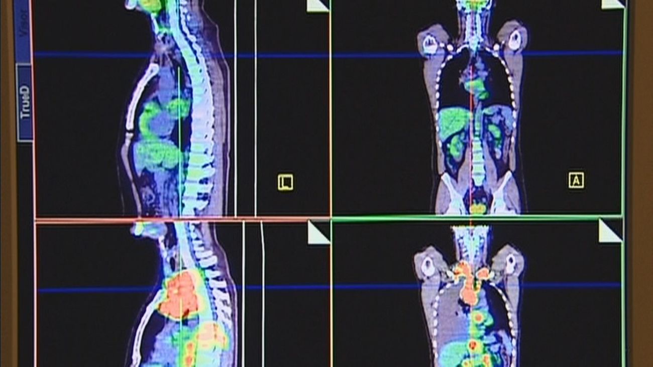 La FJD ensaya en humanos la primera vacuna contra el cáncer de pulmón