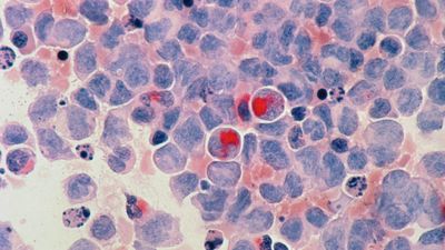 Presentan CHIEF, una IA similar a ChatGPT capaz de evaluar hasta 19 tipos de cáncer