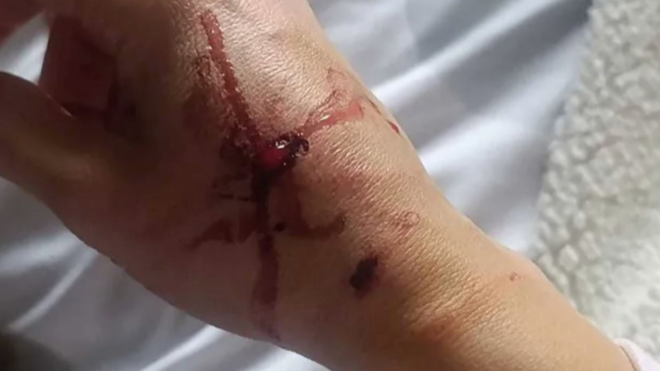 Una policía salva su vida tras ser atacada por un pitbull en un registro antidroga en Villaverde