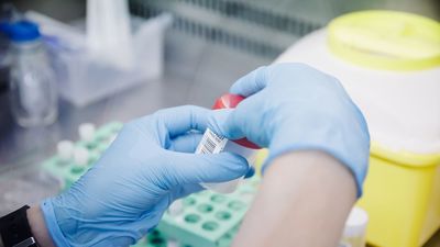 Sanidad incluye a las personas con VIH en la cobertura de las terapias CAR-T