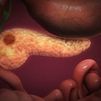 Hallan el mecanismo genético que indica un mayor riesgo de sufrir cáncer de pancreas