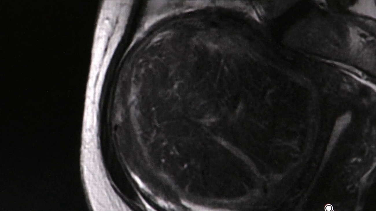 Cómo tratar los miomas sin recurrir a la cirugía invasiva