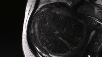 Cómo tratar los miomas sin recurrir a la cirugía invasiva