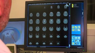 Radiofármacos contra meningiomas, la terapia alternativa que ha puesto en marcha el Hospital 12 de Octubre