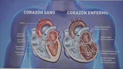 Insuficiencia cardíaca: una patología silenciosa pero común