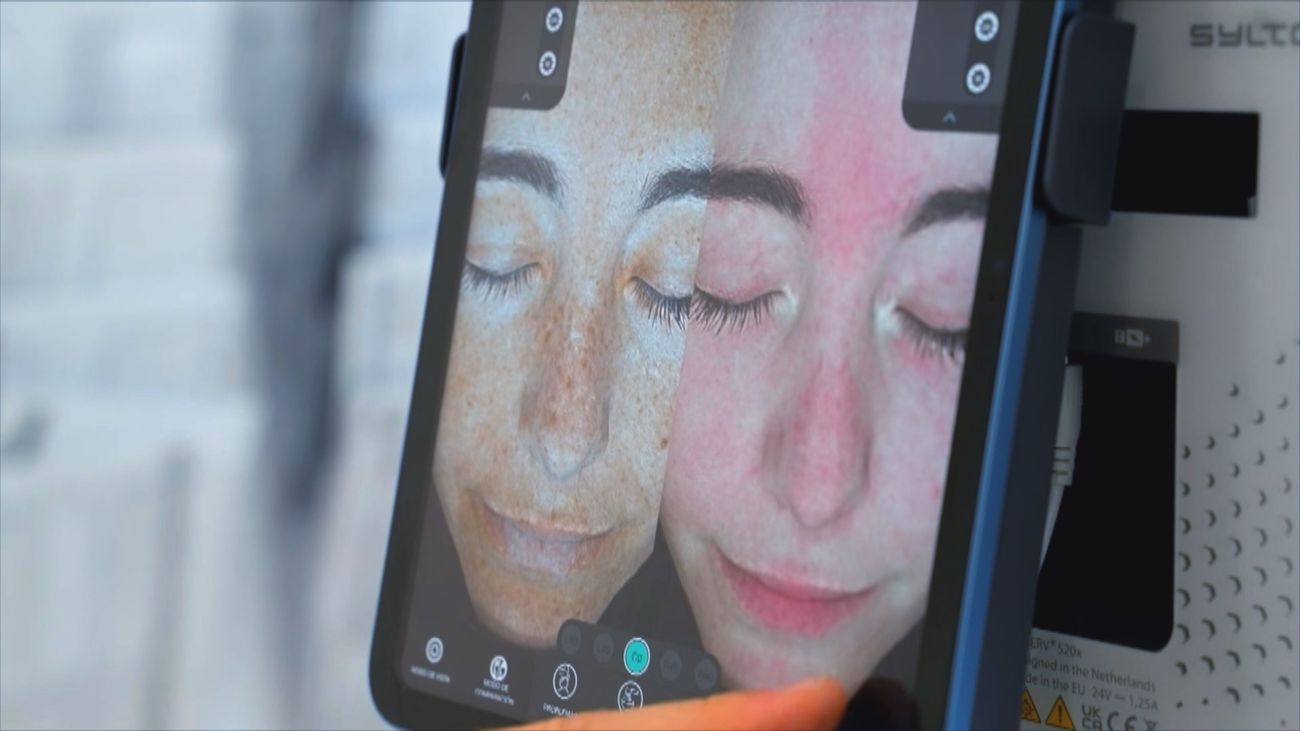 Cómo prevenir y tratar el melasma, la mancha cutánea que afecta sobre todo a mujeres