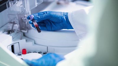 Detectar tumores con una simple muestra de sangre, la nueva y esperanzadora prueba contra el cáncer