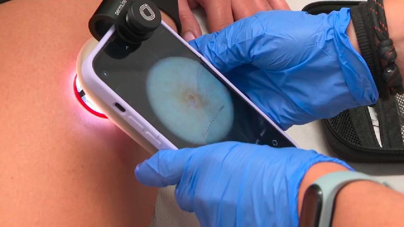 Se amplía el servicio Telederma de la Comunidad de Madrid para consultas directas con dermatólogos