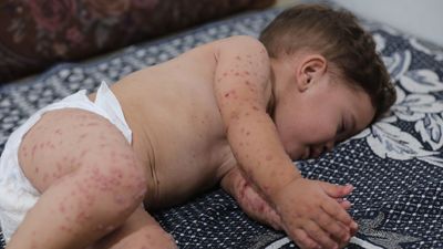 La ONU denuncia que 21.000 niños gazatíes han quedado discapacitados desde el inicio de la guerra