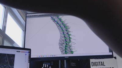 La Inteligencia Artificial ya opera la columna: así reduce los riesgos en el quirófano
