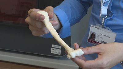 La Paz realiza el primer implante de húmero diseñado a medida en quirófano