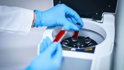 Una gota de sangre para detectar precozmante el párkinson