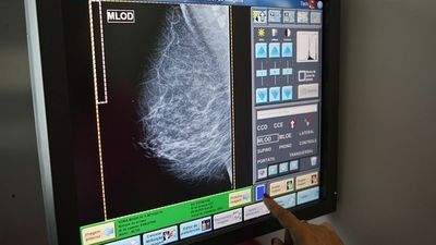 Descubren cómo ciertos tumores de mama evaden el tratamiento hormonal