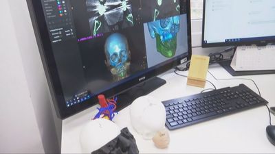 Vall d’Hebron logra el primer trasplante de cara del mundo con una donante de eutanasia