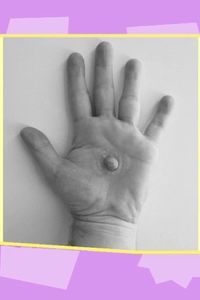 Alejandro Bralo impulsa prótesis que devuelven identidad tras el cáncer de mama