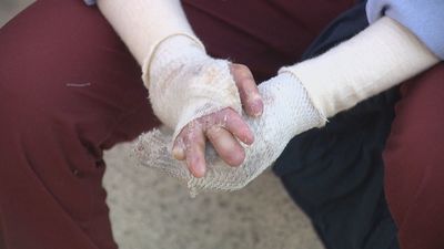 Viyuyek, el fármaco que cambiaría la vida de afectados por la piel de mariposa