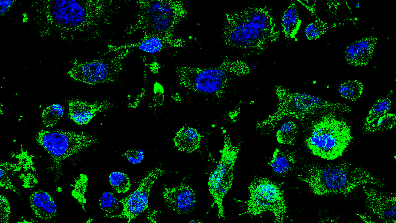 Imagen de agregados de TDP-43 (verde) fuera de los núcleos (azul) en los linfocitos de pacientes de ELA