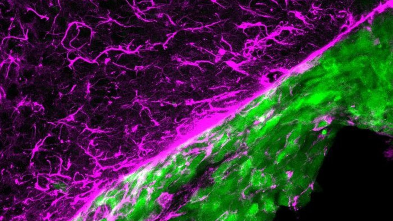 Metástasis (verde) creciendo en el cerebro (morado)