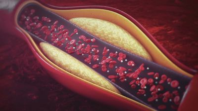 ¿Qué es el colesterol 'malo'? Descubre cómo prevenirlo con la doctora Bellón